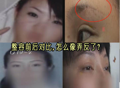 整容不成反毁容 院方称整容有“痕迹”属正常