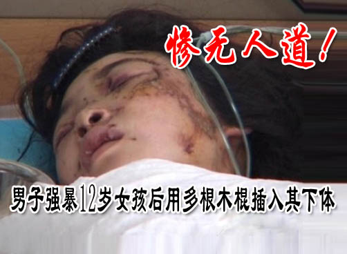被强暴女孩一根肠子仍在肚子外，右眼完全失明