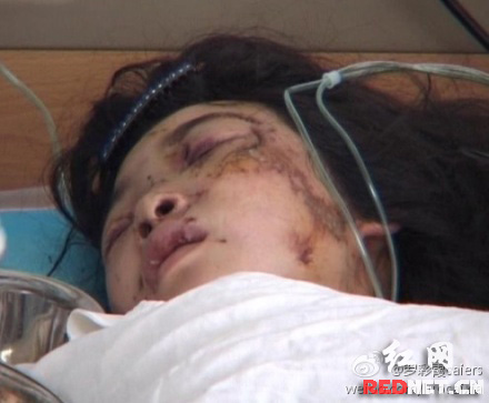 男子强暴12岁女孩后用多根木棍插入其下体