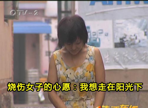 脸被烧伤惨遭毁容 杨红英盼望陪伴儿子抬头走路